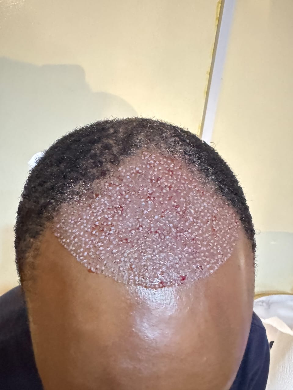 Hair Transplant Procedure